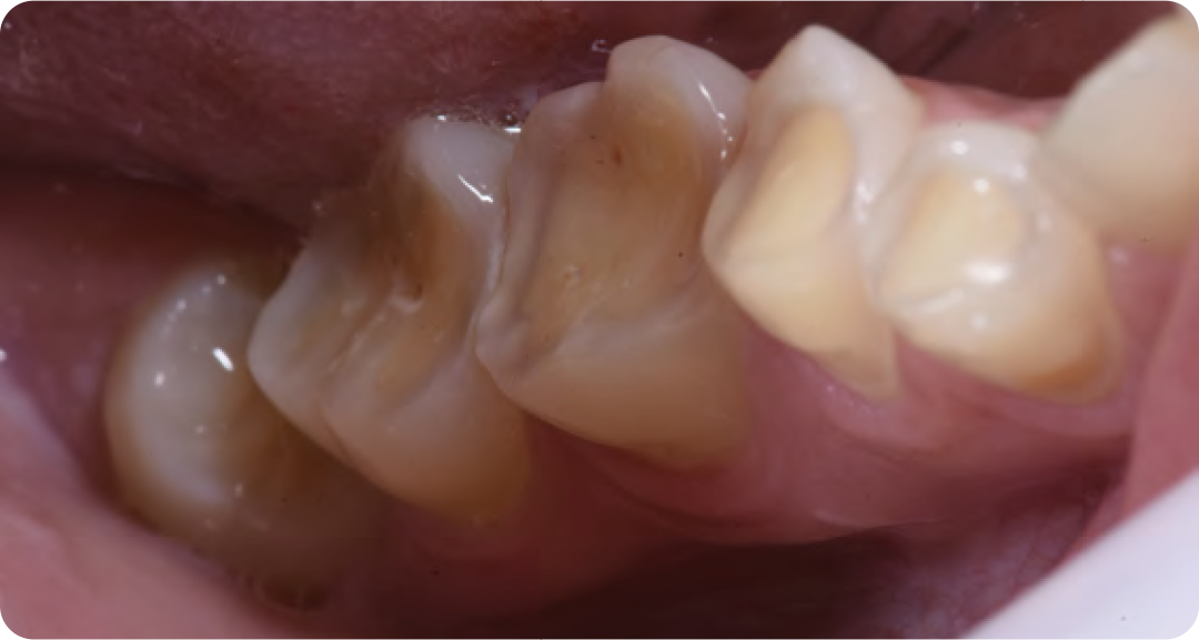 Caso clínico real — lesão cervical não cariosa (Classe V) por desgaste dental